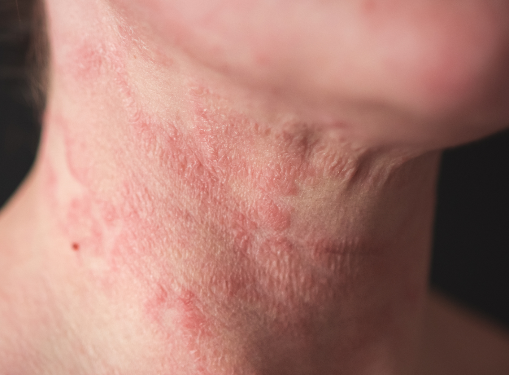 What is Atopic Dermatitis [Eczema] & Psoriasis?
