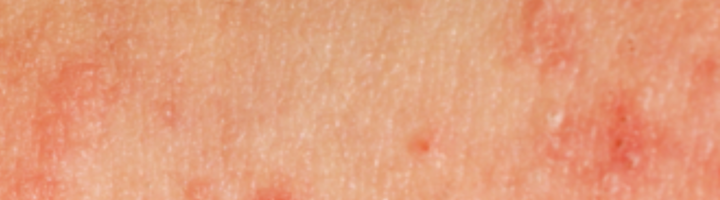 What is Atopic Dermatitis [Eczema] & Psoriasis?