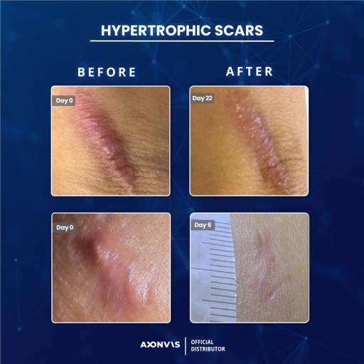 BioRNA Antiscar Patch - image 6